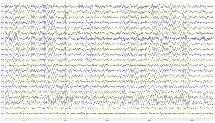 Linked ears montage EEG showing broad alpha distribution from reference contamination